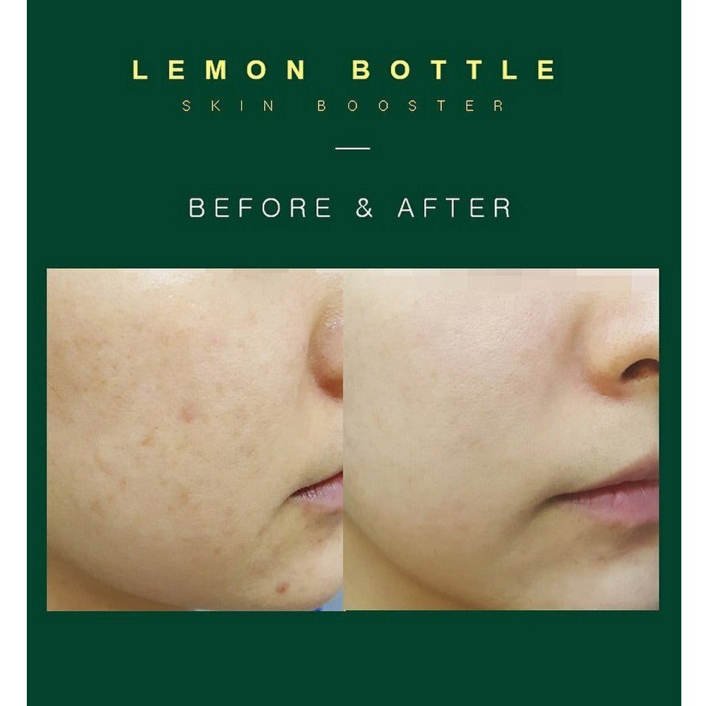 LemonBottle Skin Booster - Filler Lux