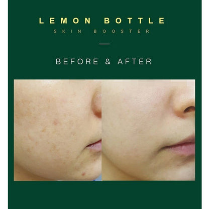 LemonBottle Skin Booster - Filler Lux